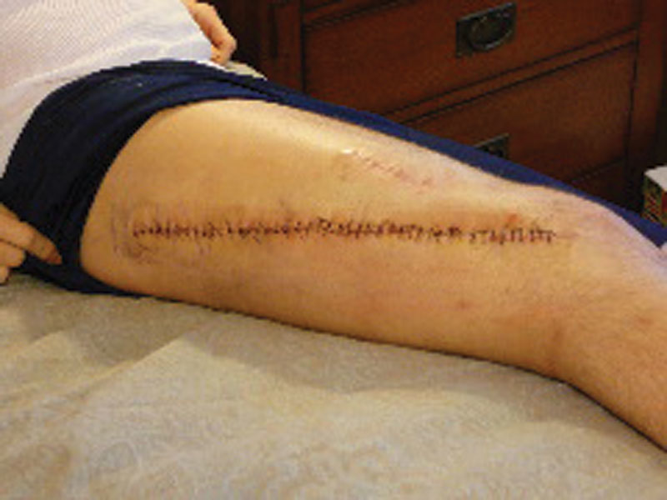 After his near-death experience, rocker Will Hoge’s life is back to normal — yet profoundly changed