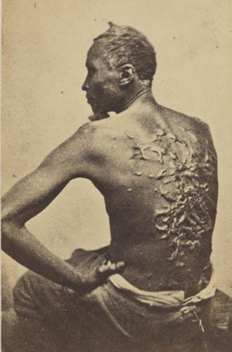 Enslaved person with heavy scarring from being whipped