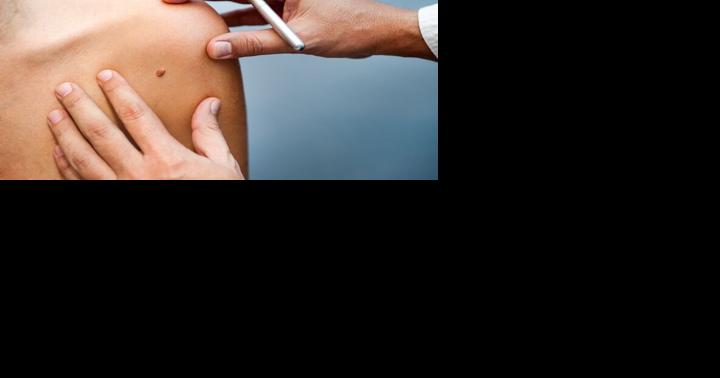 DermaHealth to provide free skin cancer screenings on March 15 - Vimarsana News