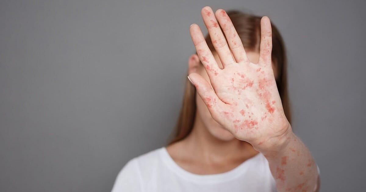 Washington state health officials warn of measles outbreak in Stevens County