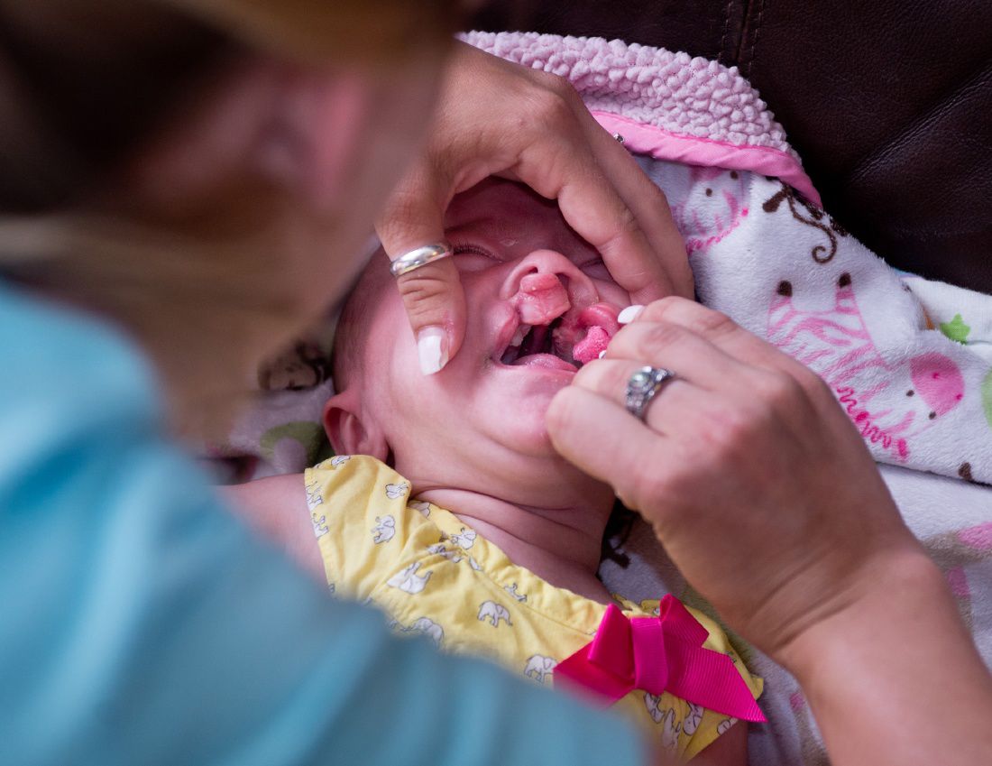 �Already beautiful� Family of baby with cleft lip, palate