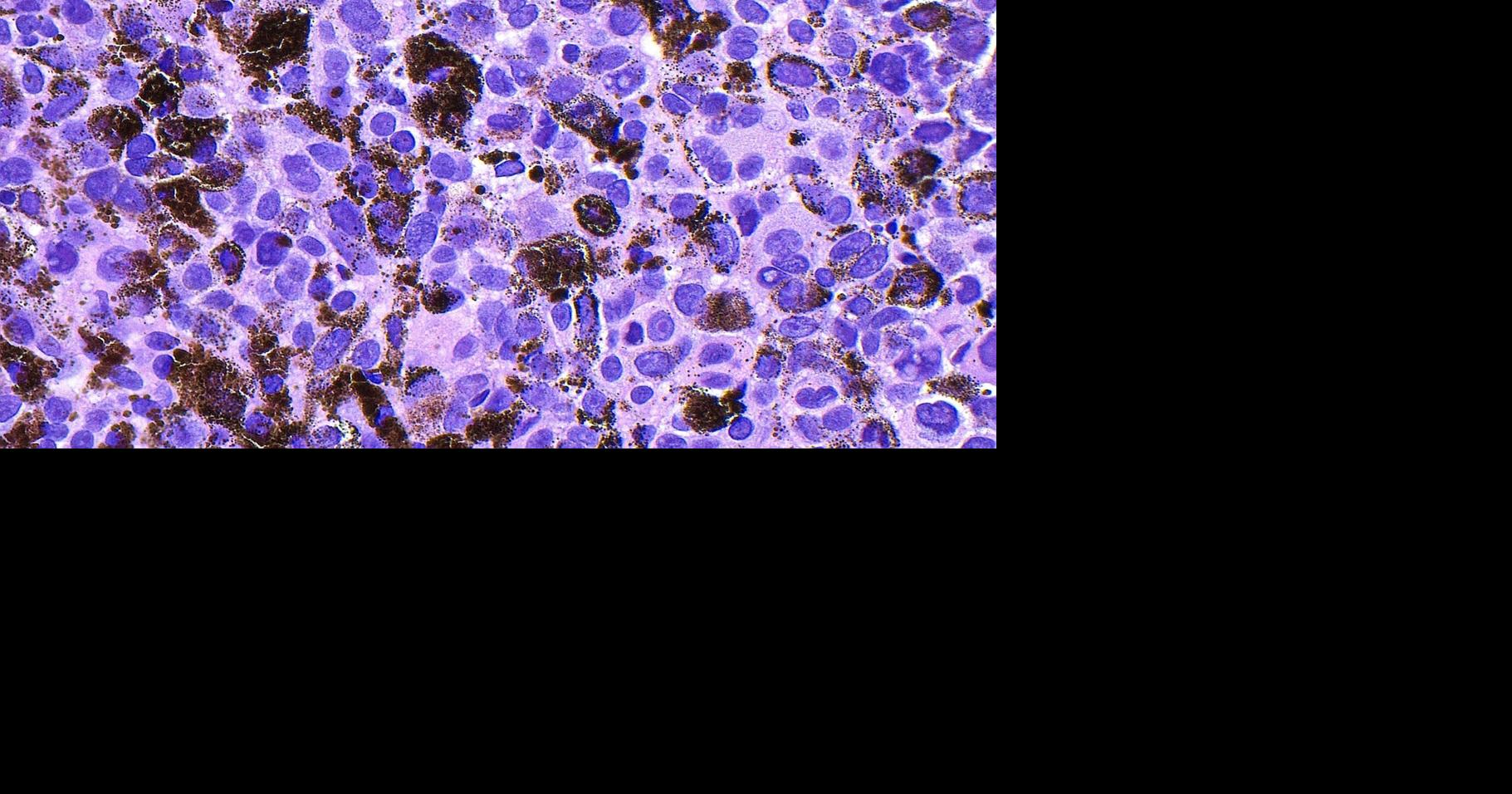 Experimental mRNA vaccine cuts risk melanoma returns by 42% | Health ...