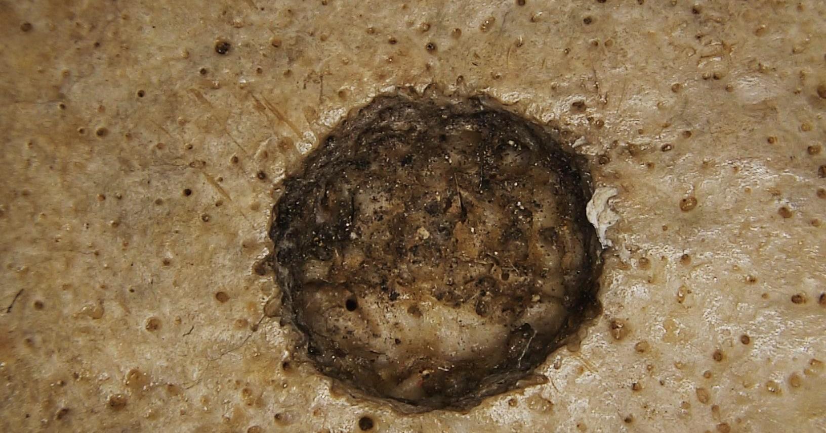 Evidence of surgical tumor removal in ancient Egyptian skull is 'milestone in the history of medicine' | National & World News - Vimarsana News
