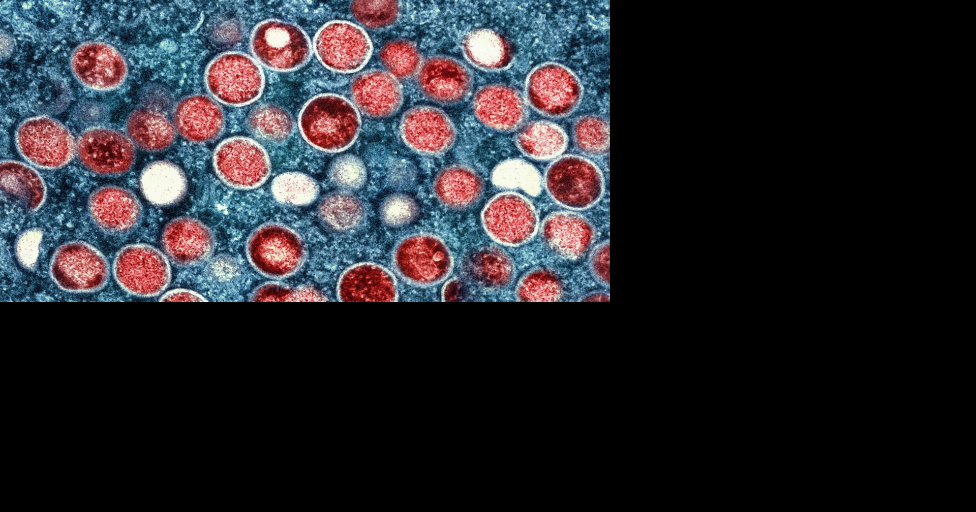 Wisconsin DHS confirms five cases of mpox in the state