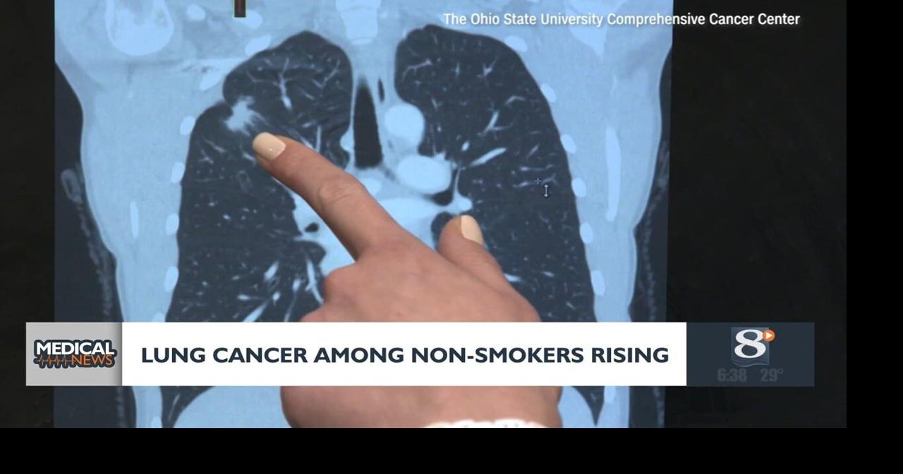 Medical Headlines: Lung cancer among non-smokers rising