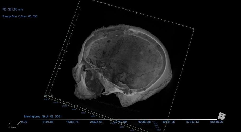 Evidence of surgical tumor removal in ancient Egyptian skull is ...