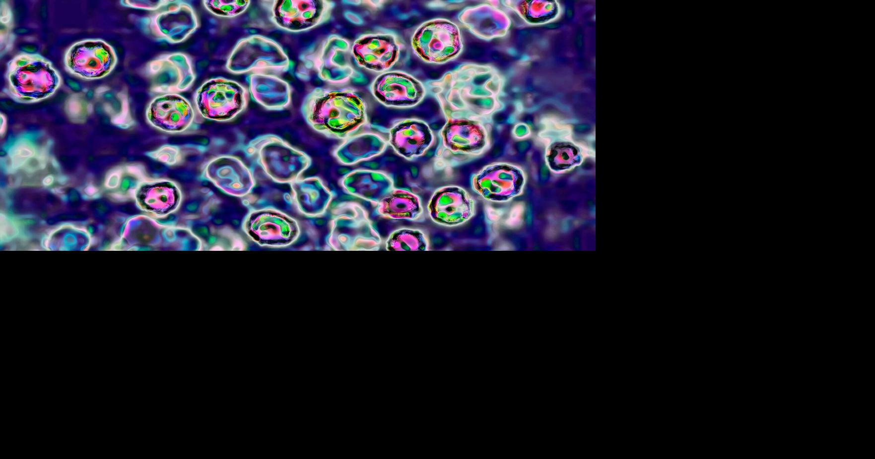 Two unvaccinated people in Pennsylvania are first measles-related deaths in US this year By Jamie Gumbrecht, Brenda Goodman, Meg Tirrell, CNN Aug 25, 2026 Aug 25, 2026 Updated 3 mins ago