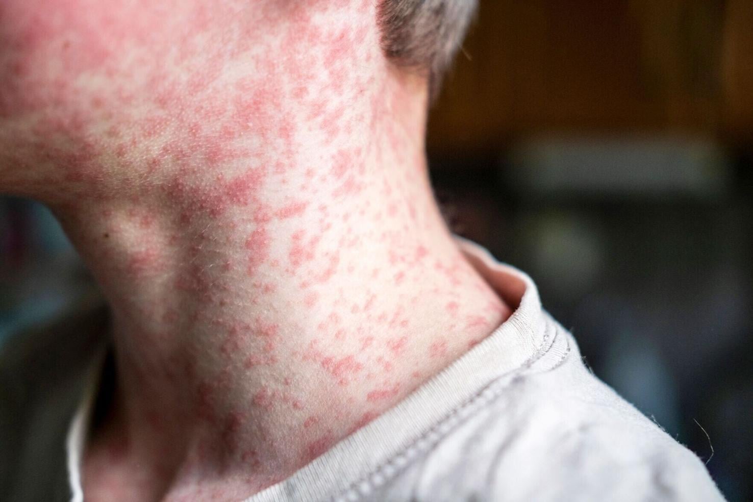 Measles outbreak in southwestern Wisconsin grows, 2 cases confirmed in ...