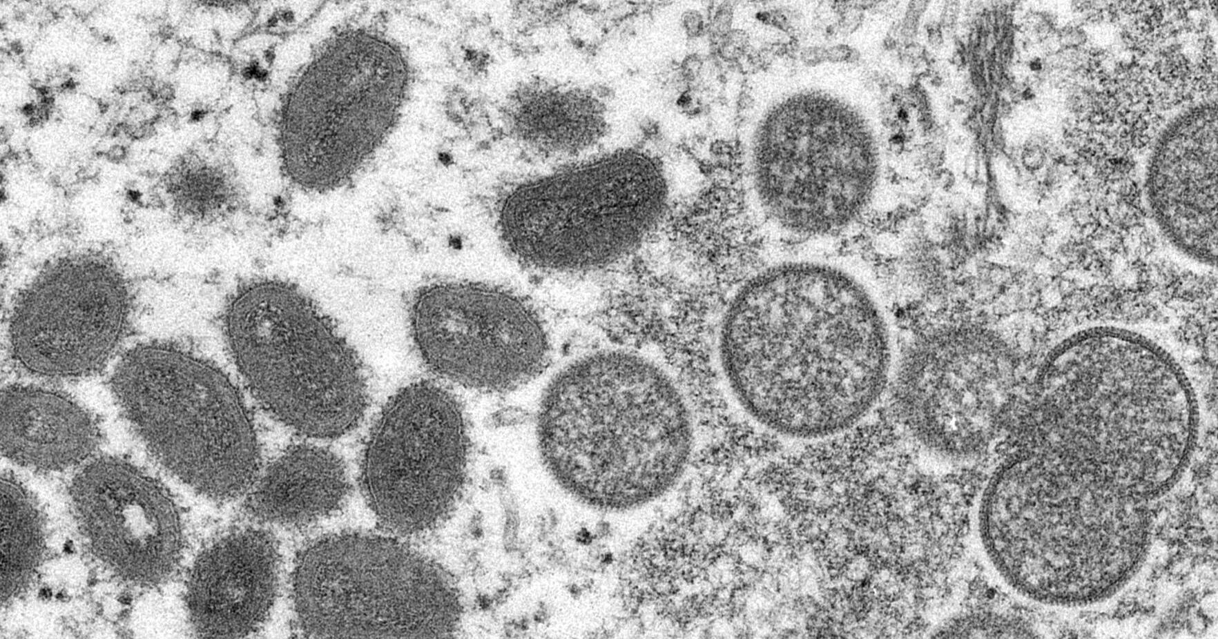 Monkeypox virus could become entrenched as new STD in the US - Vimarsana News