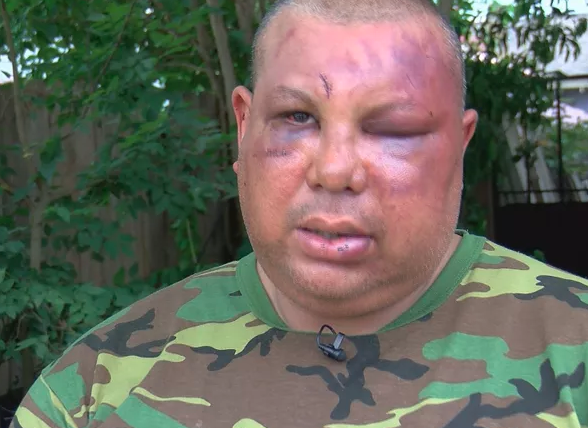 Man beaten in brawl with NOPD officers says he was called 'fake American:' Fox 8