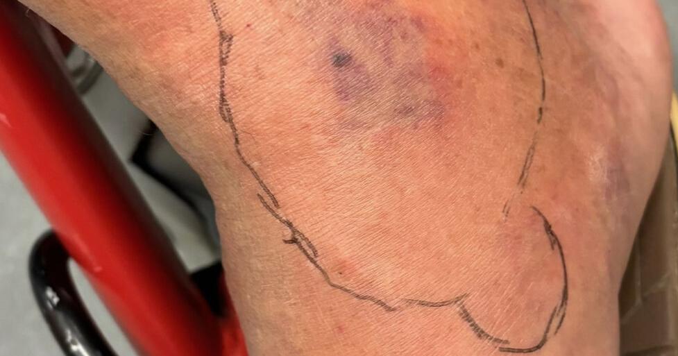 MS Coast man fighting to save his leg contracts flesh-eating bacteria on a ‘typical day’ fishing