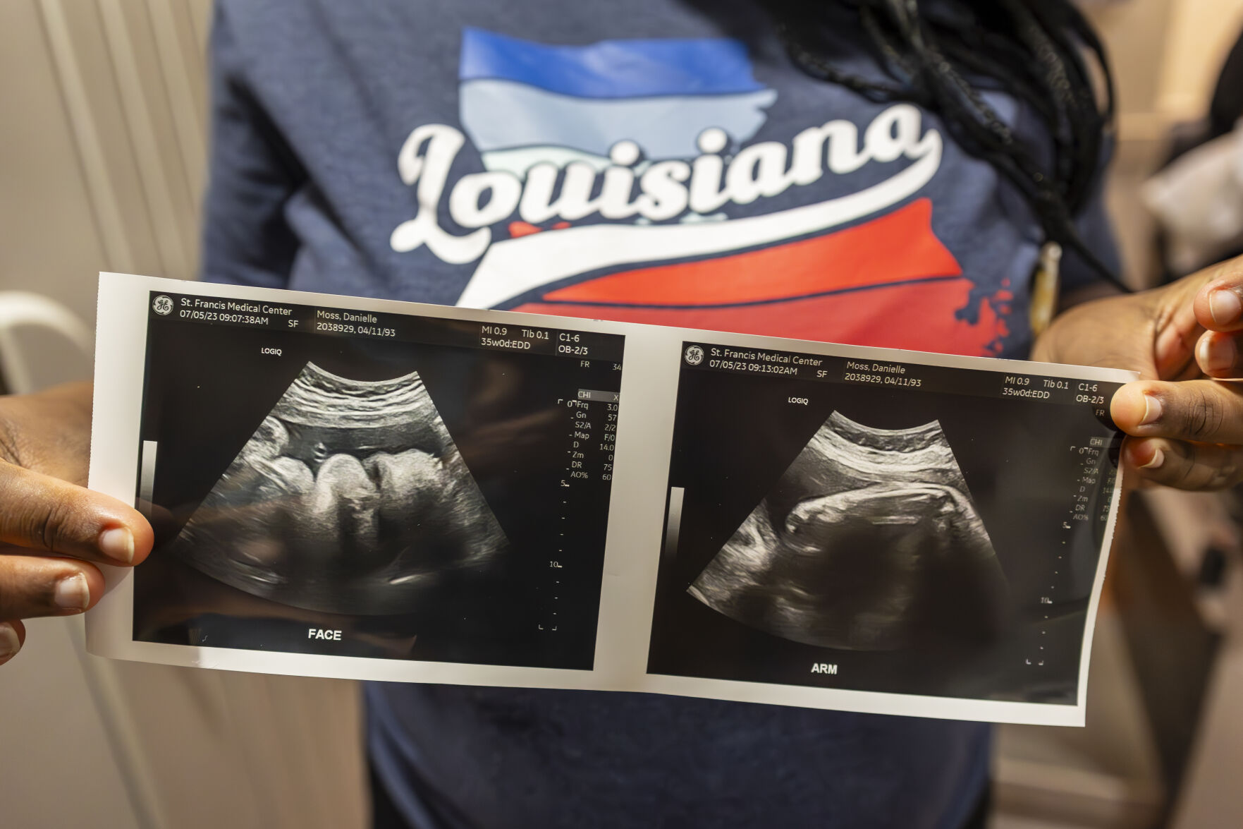 Medicaid expansion hasn't solved Louisiana infant mortality