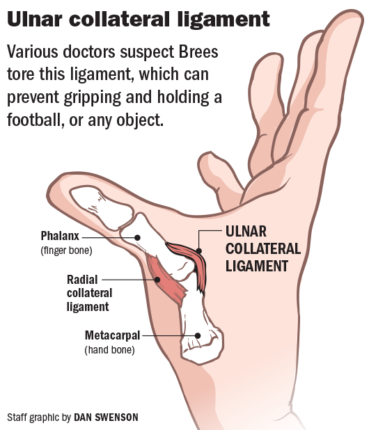 Ulnar Collateral Ligament (UCL) Injuries: Types & Symptoms