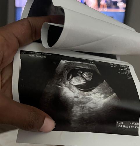 Nancy Davis ultrasound image