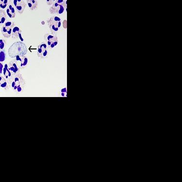 Louisiana Reports Rare Naegleria fowleri Infection Linked to Lake Swim