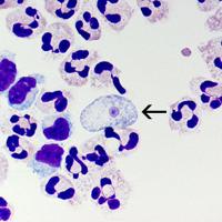 Louisiana resident infected with potentially fatal brain-eating infection