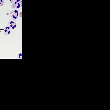 CDC Naegleria fowleri