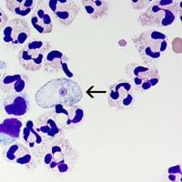 Photo: NOLA.com CDC Naegleria fowleri