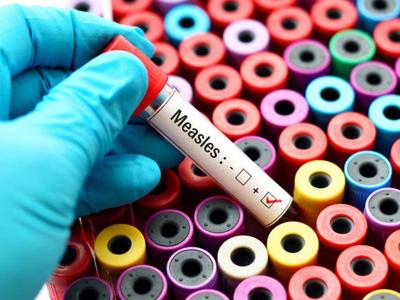 State reports measles case, warns of exposure in Kenner | Health care ...