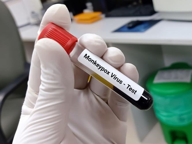Scientist hold blood sample for Monkeypox virus test