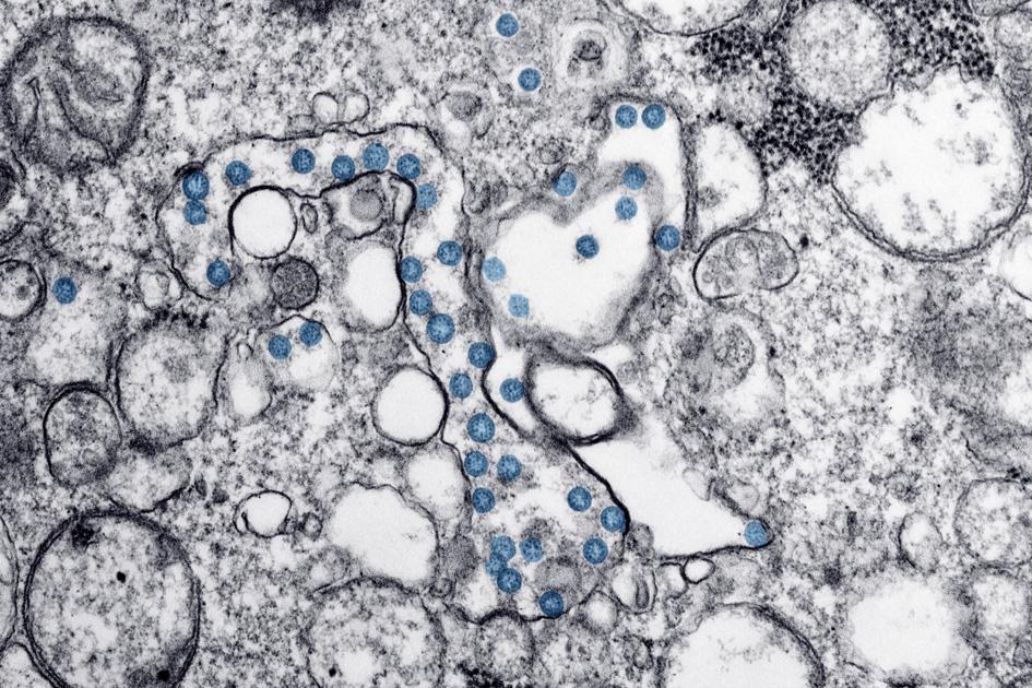 Pirmais Delta Plus gadījums, COVID “dubultā satricinājuma” variants, kas atklāts Luiziānā  Korona vīruss