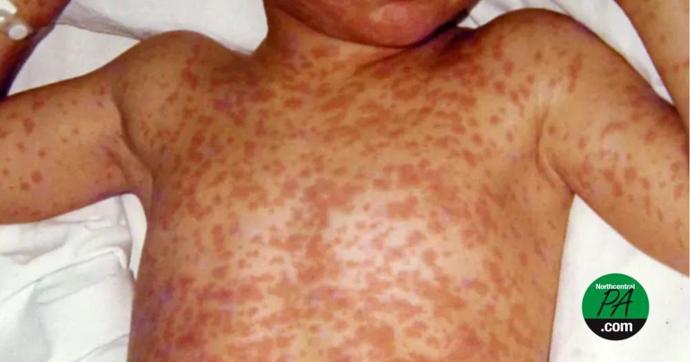 PA urged to vaccinate to prevent spread of measles this summer Danielle Smith, Keystone State News Jun 2, 2026 9 sec ago