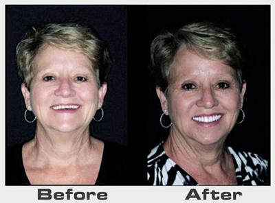 Introducing Facelift Dentures The Fountain Of Youth For Denture Wearers Archives Northfulton Com