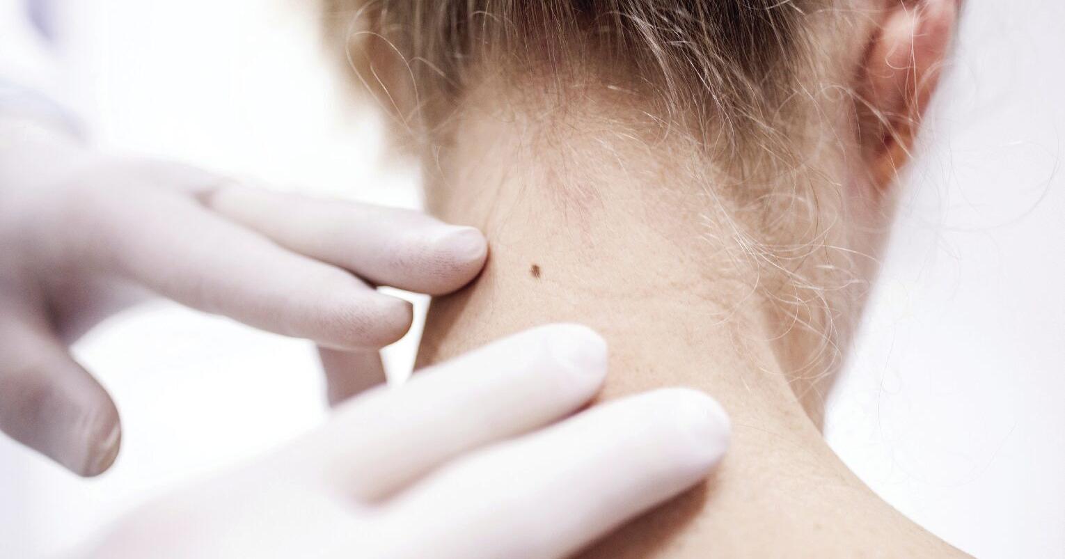 To catch skin cancer early, remember ABCDE - Vimarsana News