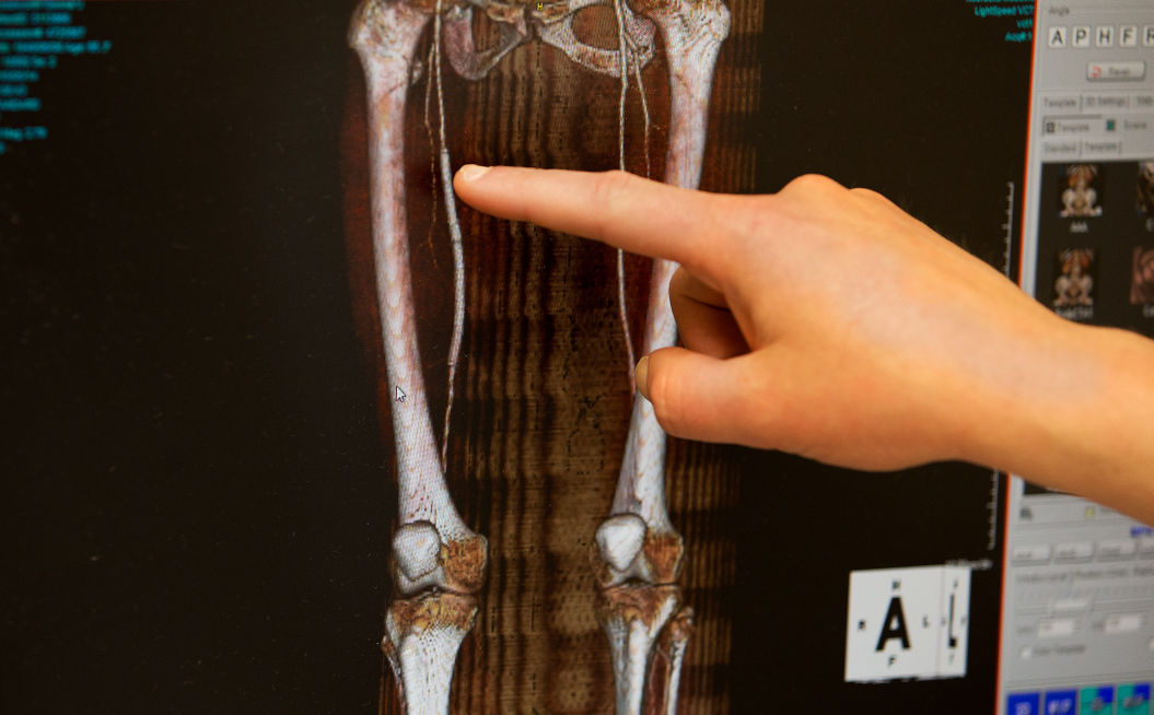 Why Do Leg Stents Fail So Fast UNMC Has A 3 5 Million Grant To Find Out Health Omaha