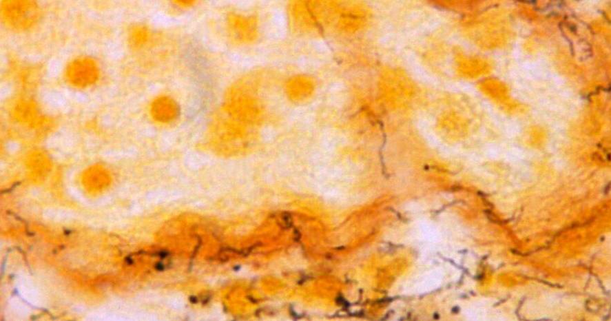 Syphilis cases in US newborns skyrocketed in 2022 - Vimarsana News