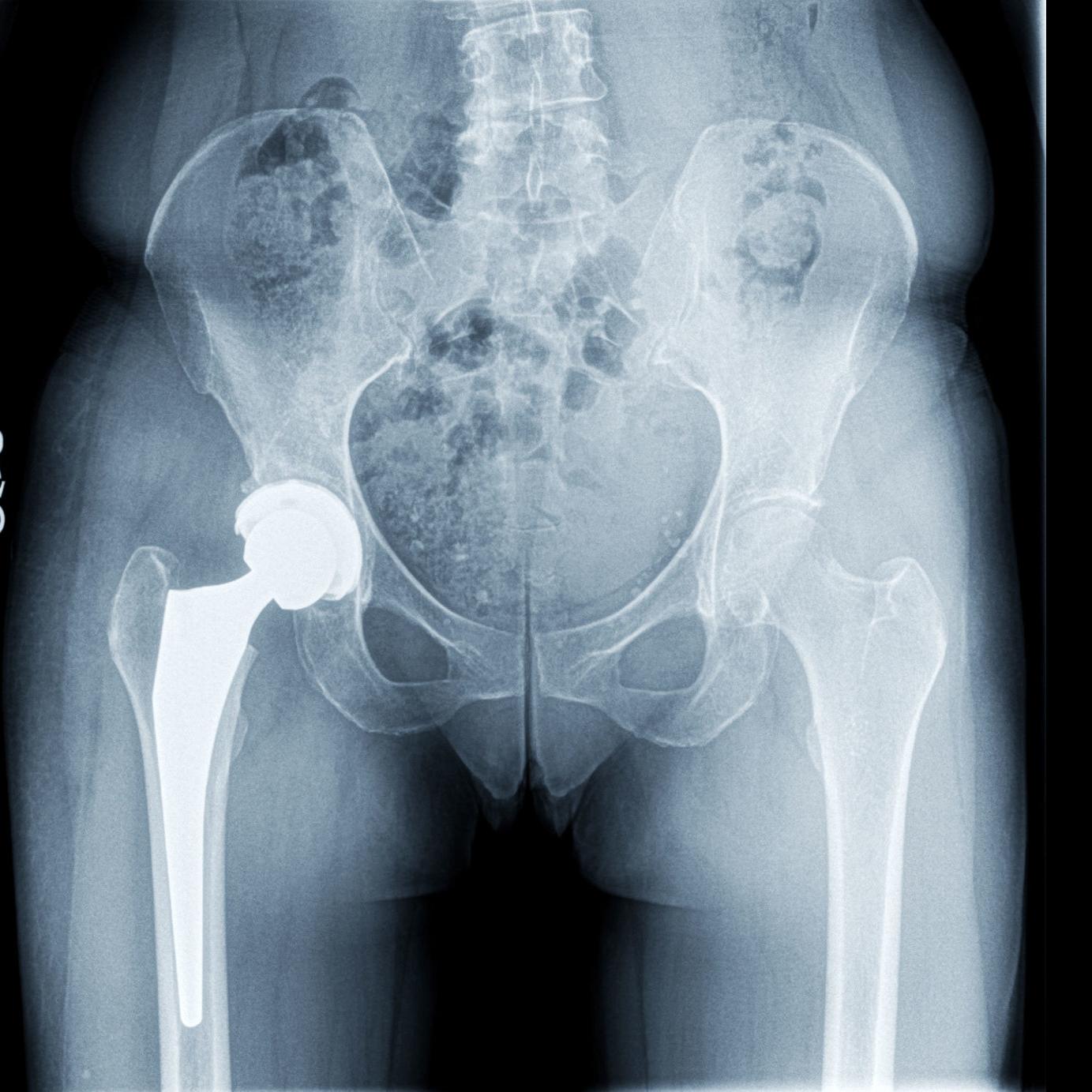 Surgeon Anterior Hip Replacement Is Viable Option For A Broad Range Of Patients Sponsored Features Omaha Com