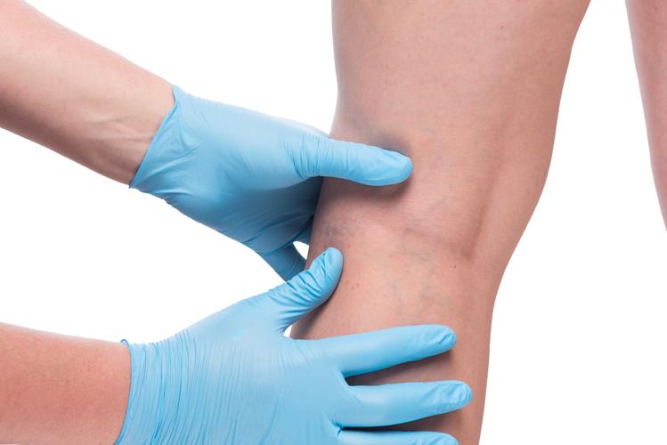 Varicose and spider veins