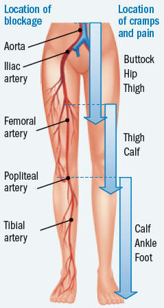 Leg pain