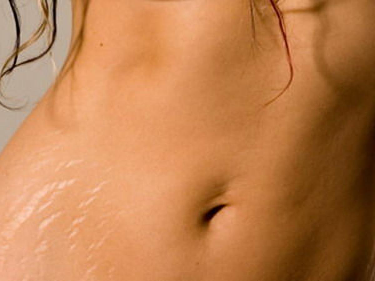 4 Ways To Make Stretch Marks Less Noticeable Momaha Omaha Com 4 Ways To Make Stretch Marks Less Noticeable Momaha Omaha Com
