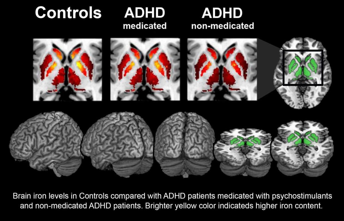 hyperactivity brain