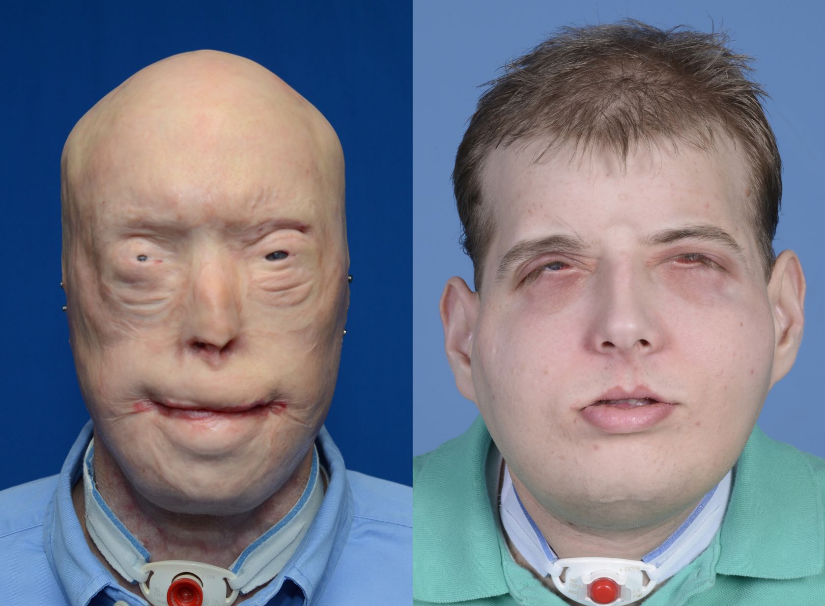 71 surgeries and a transplant give new face to burned firefighter