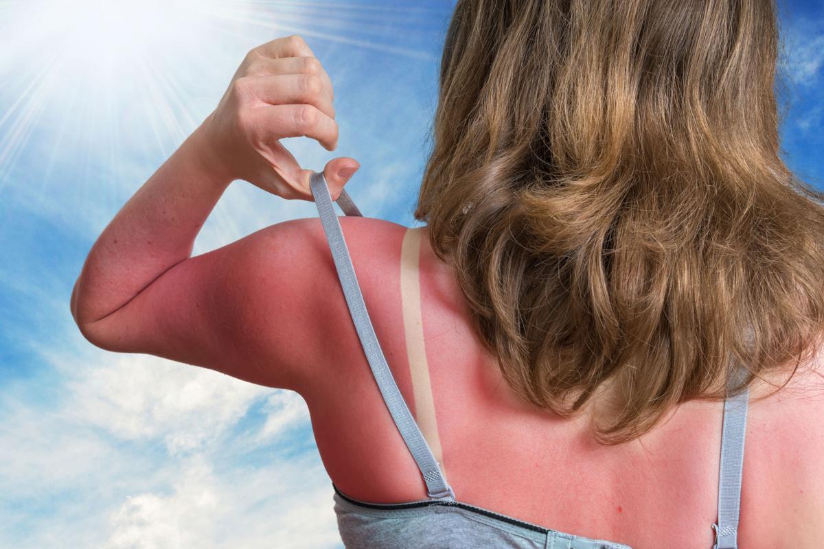 Home Remedies Treating Your Sunburn Features Postandcourier Com
