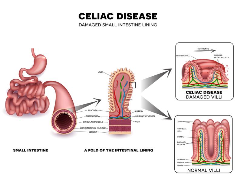 Study Screen Families Of Celiac Disease Patients Lifestyle Postguam Com