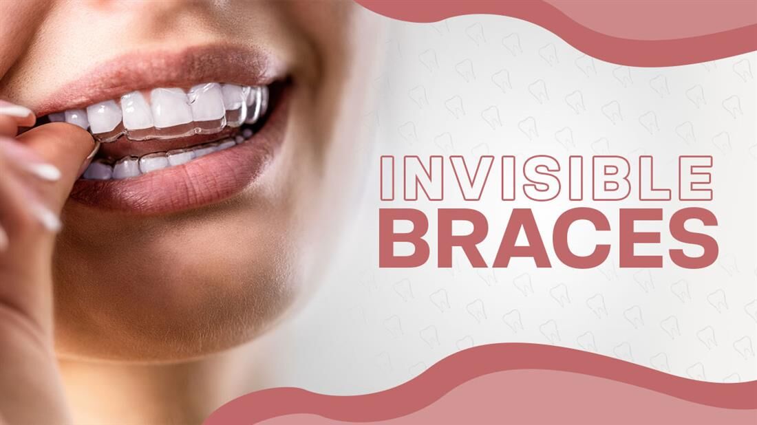 Best Invisible Braces Companies: Pricing & Treatment Plans | Best Daily ...