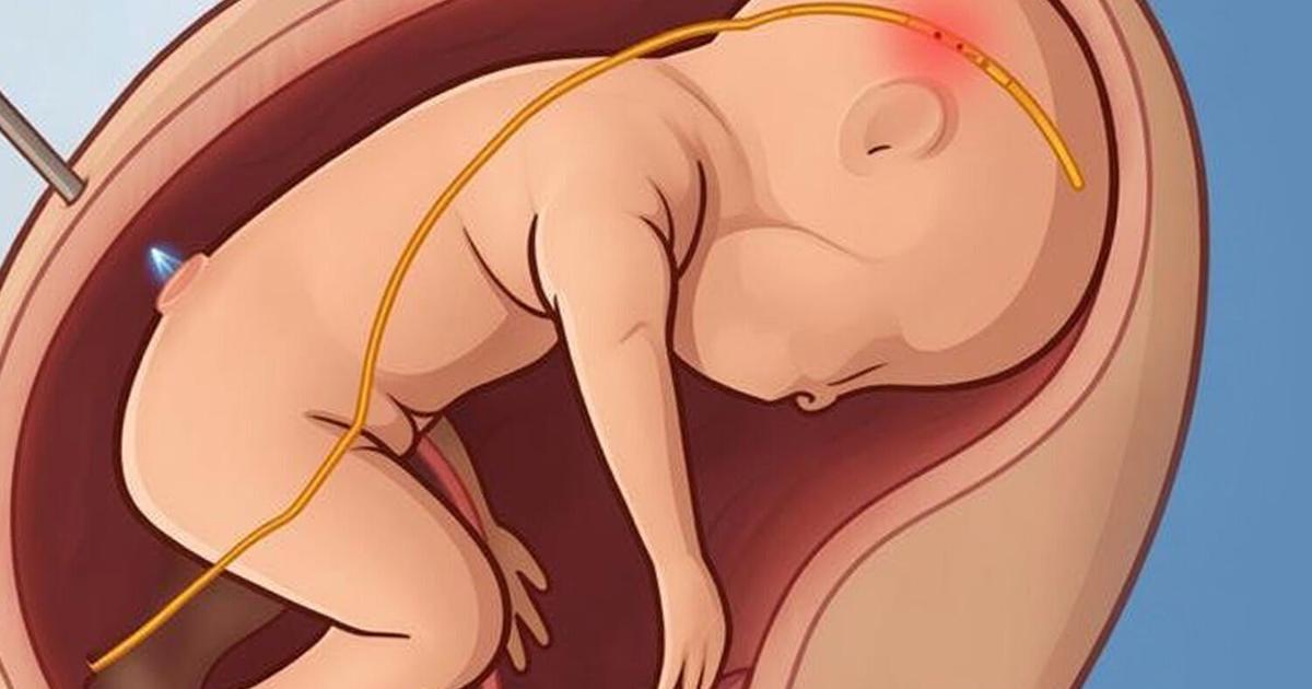 Tiny probe monitors unborn baby’s health inside womb during surgery | Health Tiny probe monitors unborn baby’s health inside womb during surgery | Health