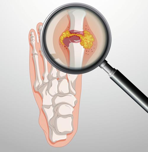 Gout