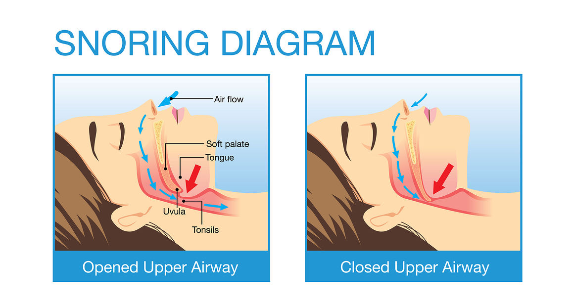 Sleep apnea the serious sleep disorder