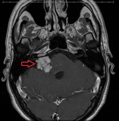 From a Tumor to a Tom: A Tale of Perseverance