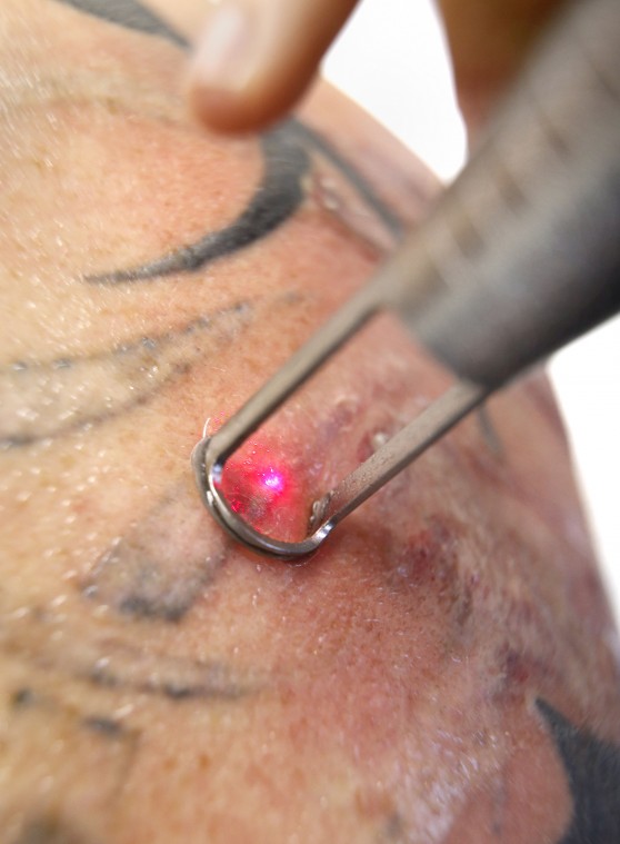 Laser Tattoo Removal For Men in Richmond