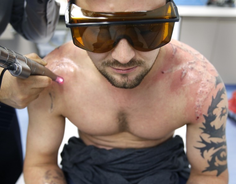 Laser Tattoo Removal  Richmond  Mechanicsville VA