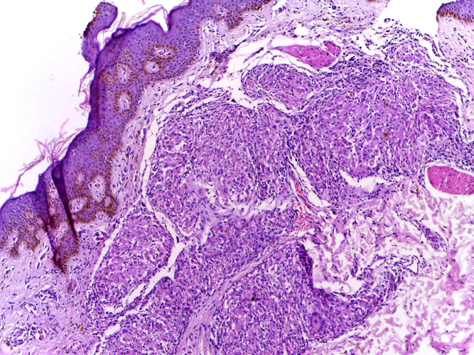 Was leprosy a social death sentence during medieval times? | Health ...