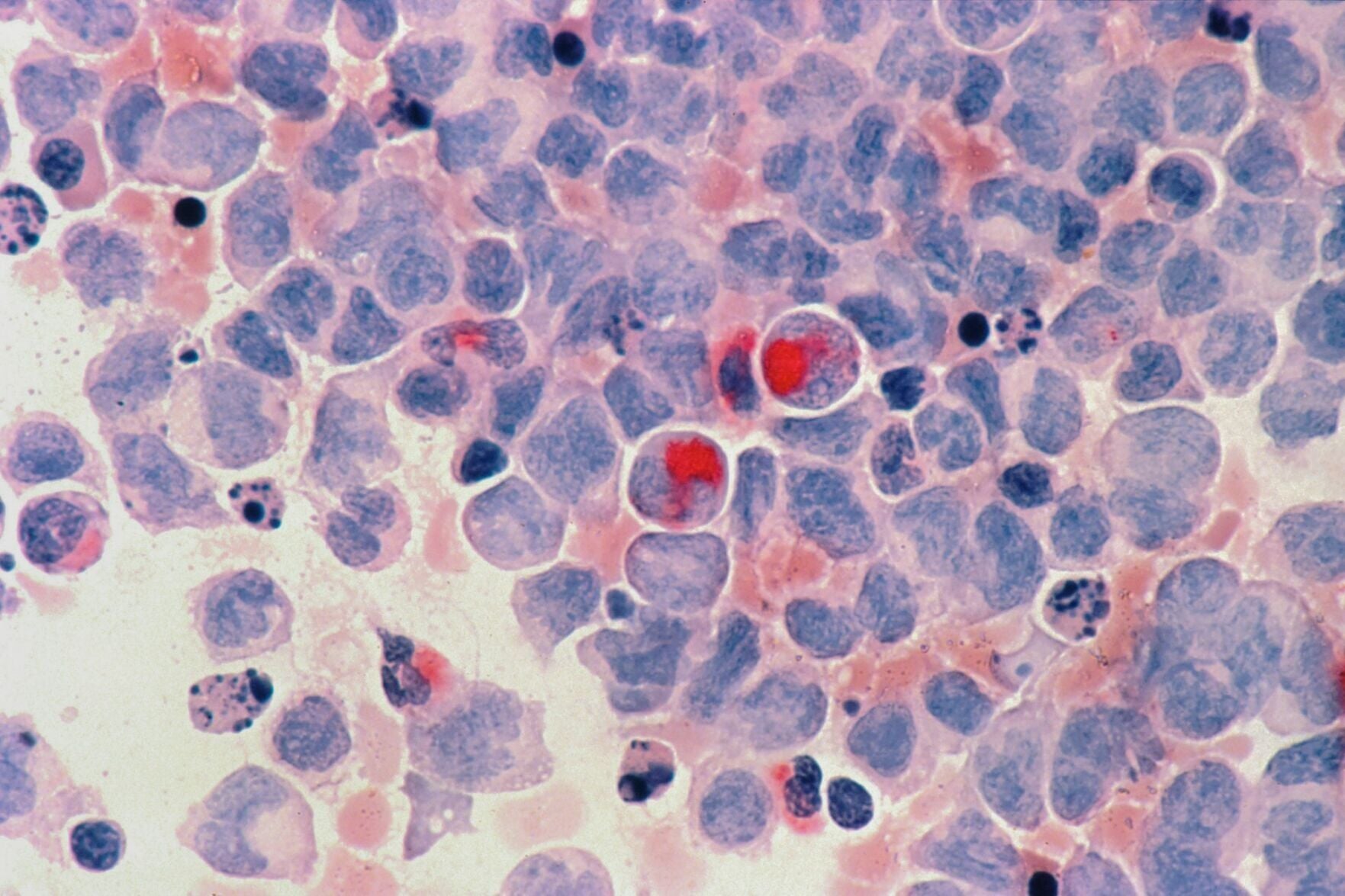 AI can estimate cancer patients’ survival risk from a single photo ...