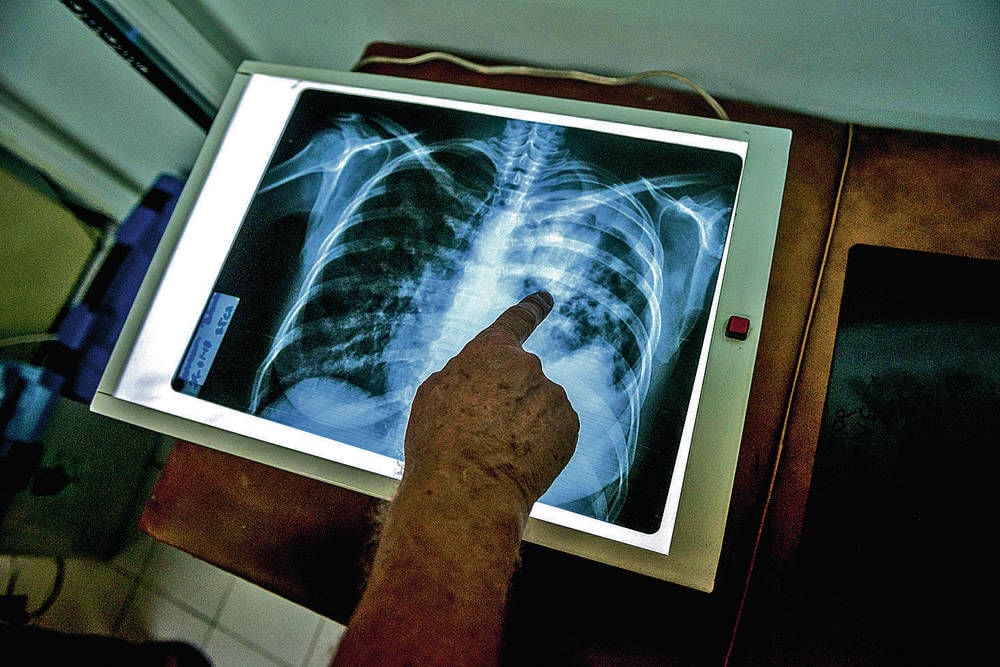 tuberculosis is disappearing in the u.s. — but not fast enough