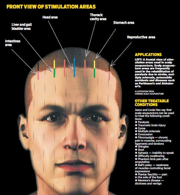 Multiple sclerosis facial paralysis