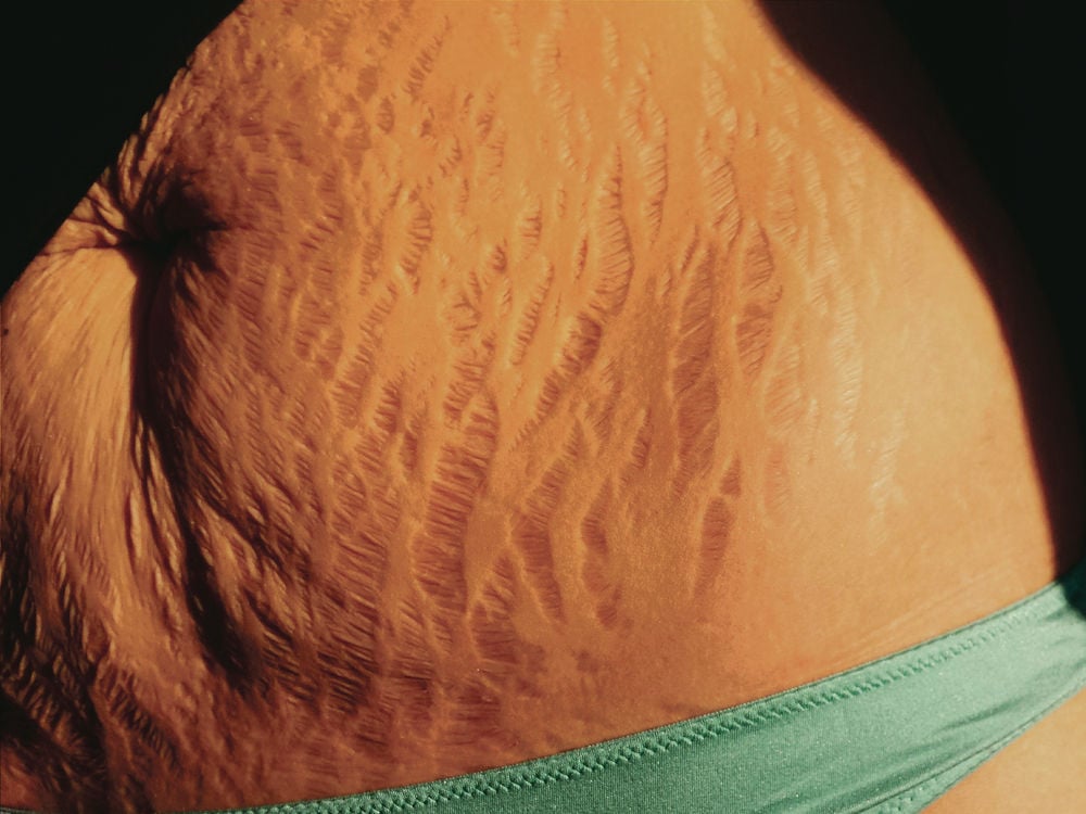 Love Your Lines Stretch marks go viral in support of women Family